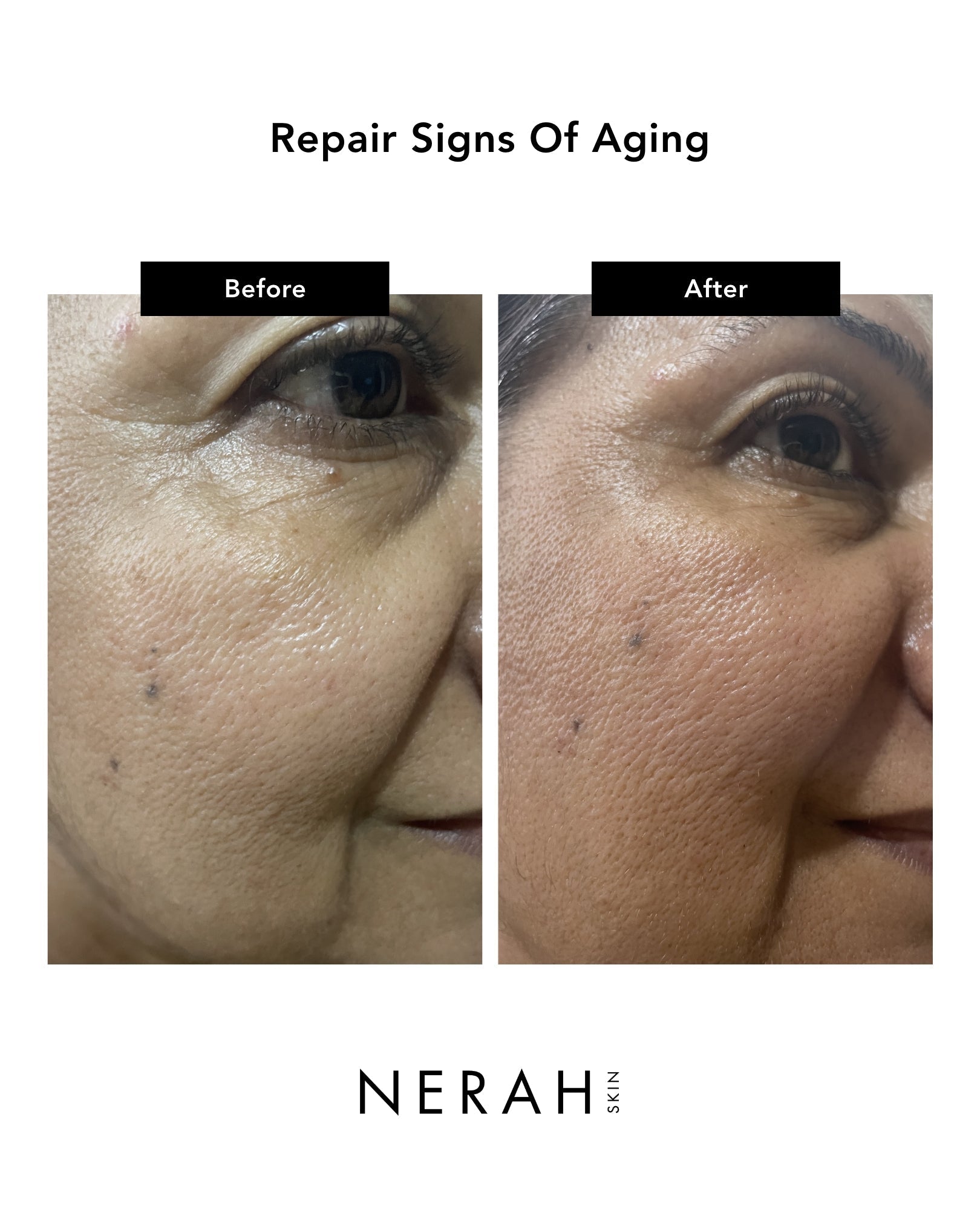 Calm & Care Duo | Noni Peeling Gel & Kudzu Restoring Serum Bundle Nerah Skin